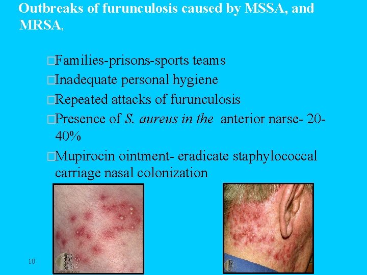 Outbreaks of furunculosis caused by MSSA, and MRSA, �Families-prisons-sports teams �Inadequate personal hygiene �Repeated