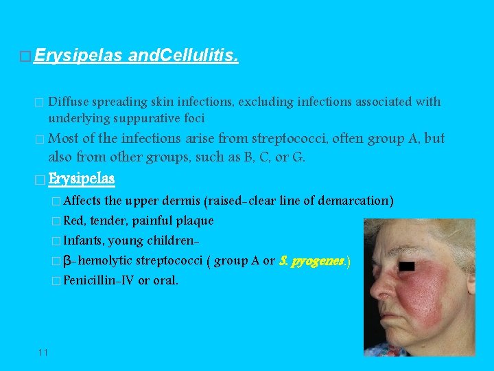 � Erysipelas � and. Cellulitis. Diffuse spreading skin infections, excluding infections associated with underlying