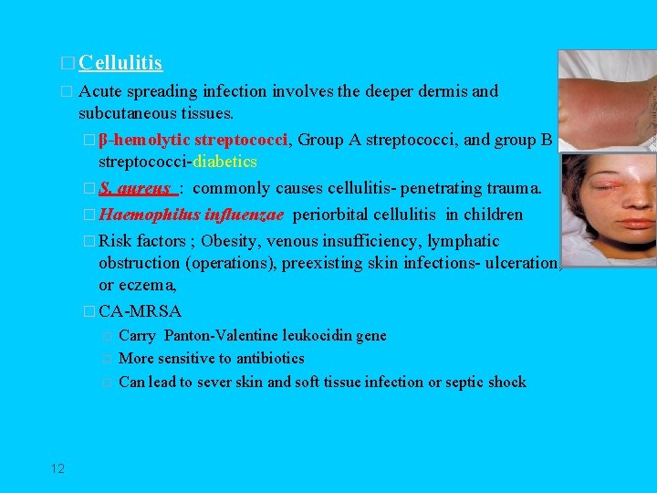 � Cellulitis � Acute spreading infection involves the deeper dermis and subcutaneous tissues. �