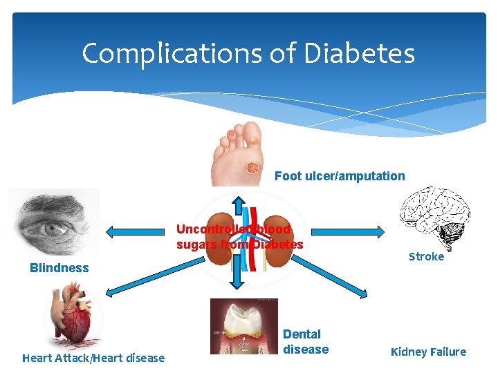 Complications of Diabetes Foot ulcer/amputation Uncontrolled blood sugars from Diabetes Blindness Heart Attack/Heart disease