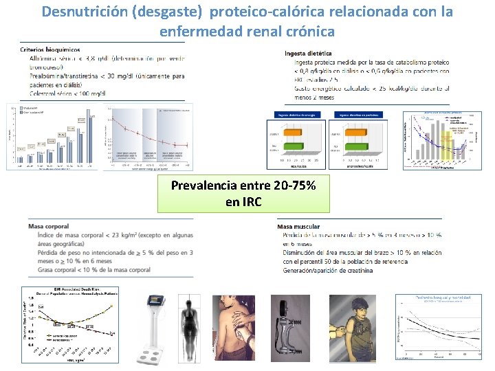 Desnutrición (desgaste) proteico-calórica relacionada con la enfermedad renal crónica Prevalencia entre 20 -75% en