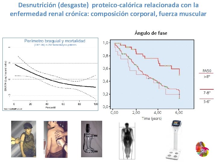 Desnutrición (desgaste) proteico-calórica relacionada con la enfermedad renal crónica: composición corporal, fuerza muscular Ángulo