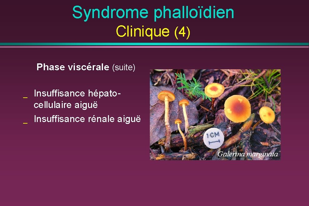 Syndrome phalloïdien Clinique (4) Phase viscérale (suite) _ _ Insuffisance hépatocellulaire aiguë Insuffisance rénale