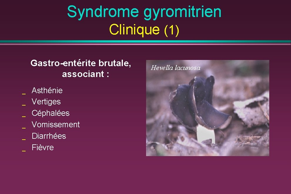 Syndrome gyromitrien Clinique (1) Gastro-entérite brutale, associant : _ _ _ Asthénie Vertiges Céphalées