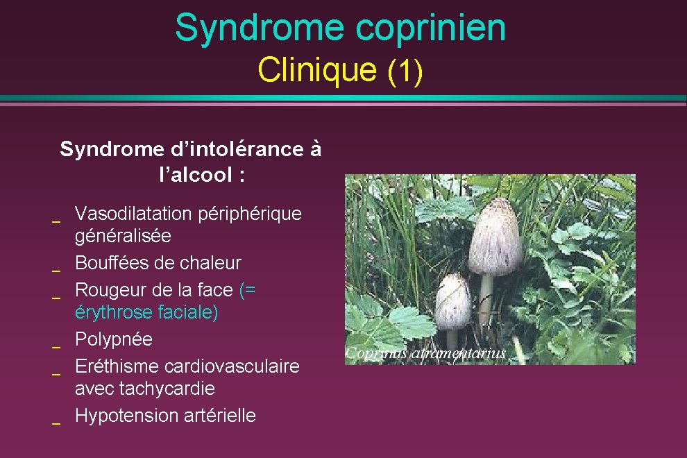Syndrome coprinien Clinique (1) Syndrome d’intolérance à l’alcool : _ _ _ Vasodilatation périphérique