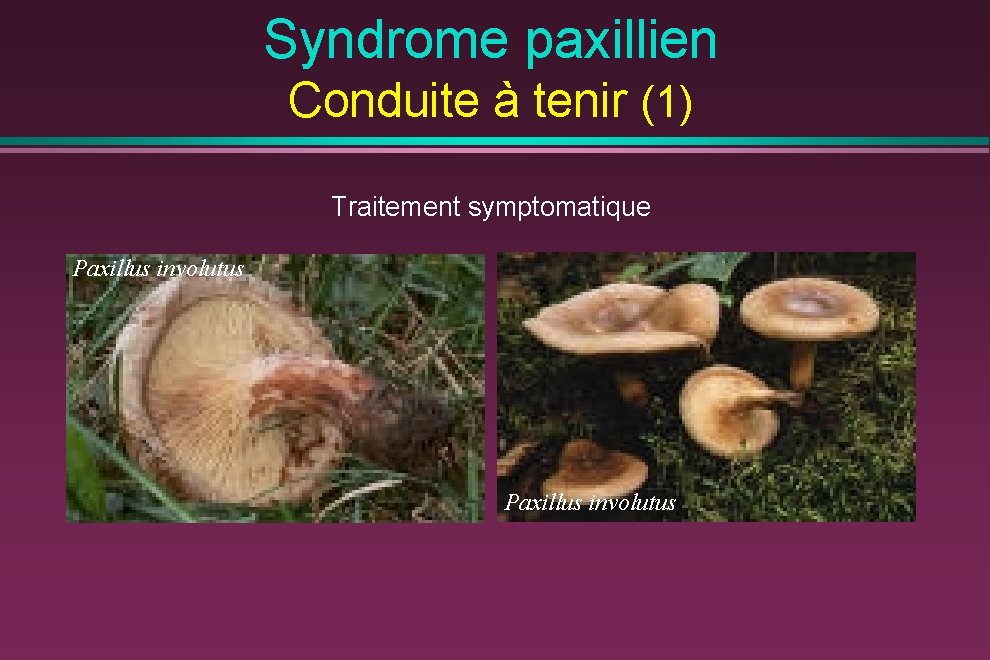 Syndrome paxillien Conduite à tenir (1) Traitement symptomatique Paxillus involutus 