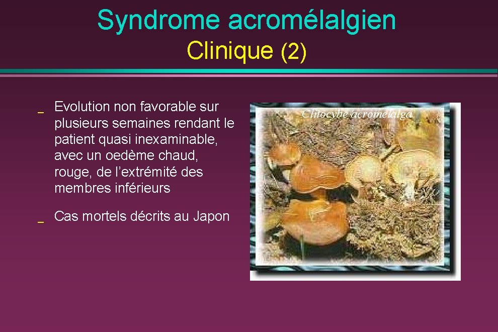 Syndrome acromélalgien Clinique (2) _ Evolution non favorable sur plusieurs semaines rendant le patient