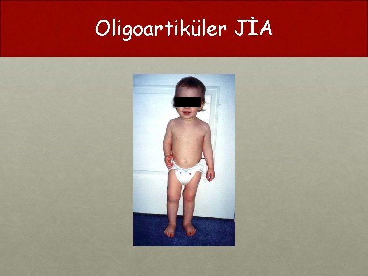 Oligoartiküler JİA 