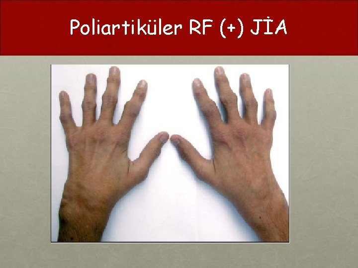 Poliartiküler RF (+) JİA 