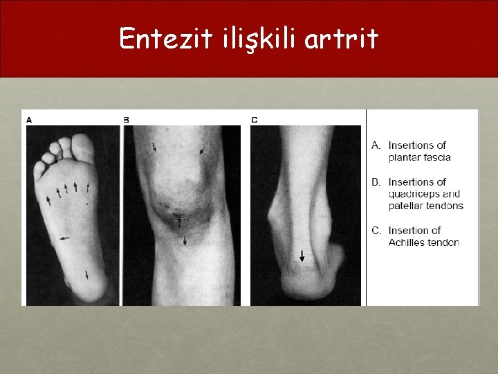 Entezit ilişkili artrit 