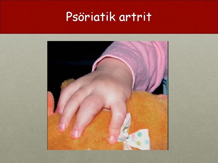 Psöriatik artrit 