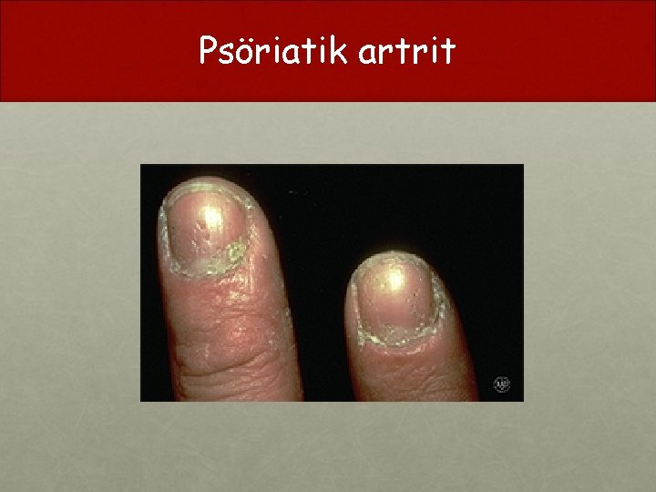 Psöriatik artrit 