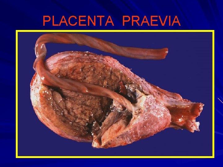 PLACENTA PRAEVIA 