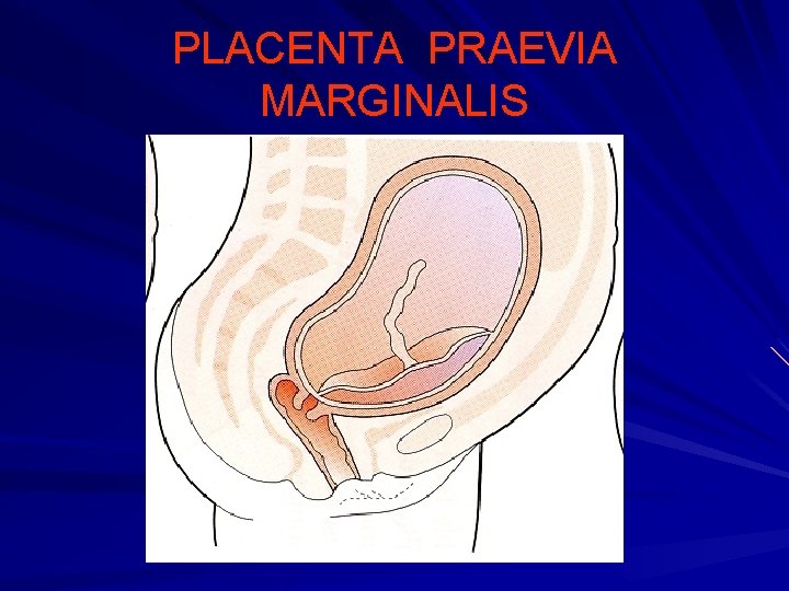 PLACENTA PRAEVIA MARGINALIS 