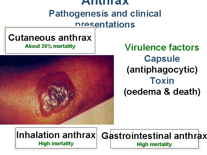Anthrax Pathogenesis and clinical presentations Cutaneous anthrax About 20% mortality Virulence factors Capsule (antiphagocytic)