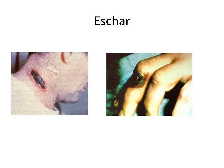 Eschar 