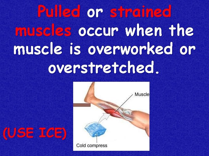 Pulled or strained muscles occur when the muscle is overworked or overstretched. (USE ICE)