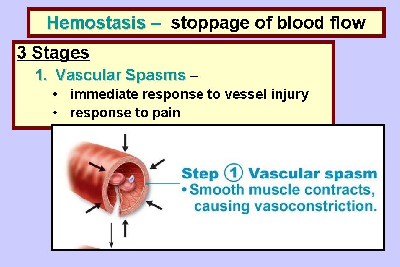 Hemostasis – stoppage of blood flow 3 Stages 1. Vascular Spasms – • immediate