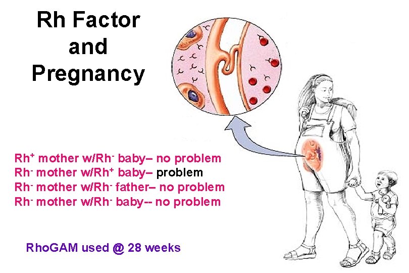 Rh Factor and Pregnancy Rh+ mother w/Rh- baby– no problem Rh- mother w/Rh+ baby–