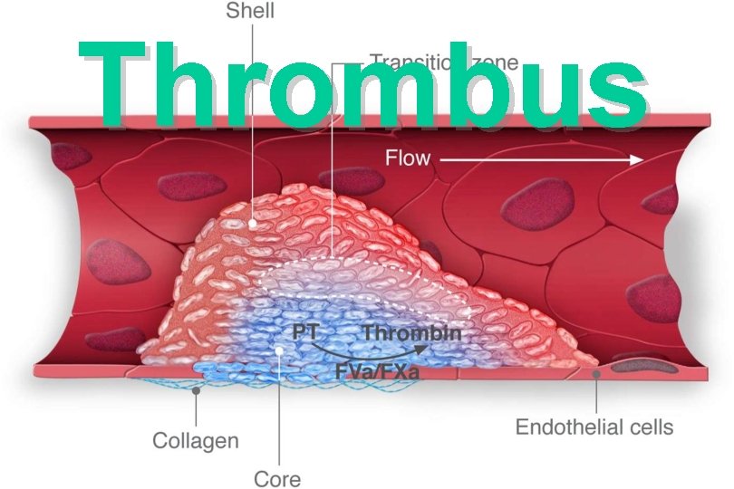 Thrombus 