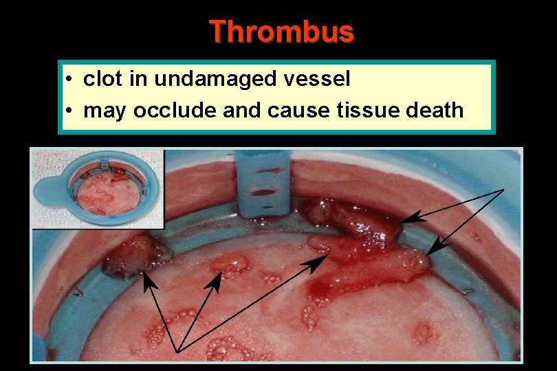 Thrombus • clot in undamaged vessel • may occlude and cause tissue death 