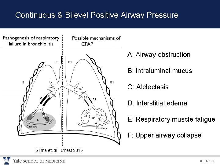 Continuous & Bilevel Positive Airway Pressure A: Airway obstruction B: Intraluminal mucus C: Atelectasis