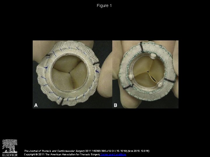 Figure 1 The Journal of Thoracic and Cardiovascular Surgery 2011 142390 -395. e 1
