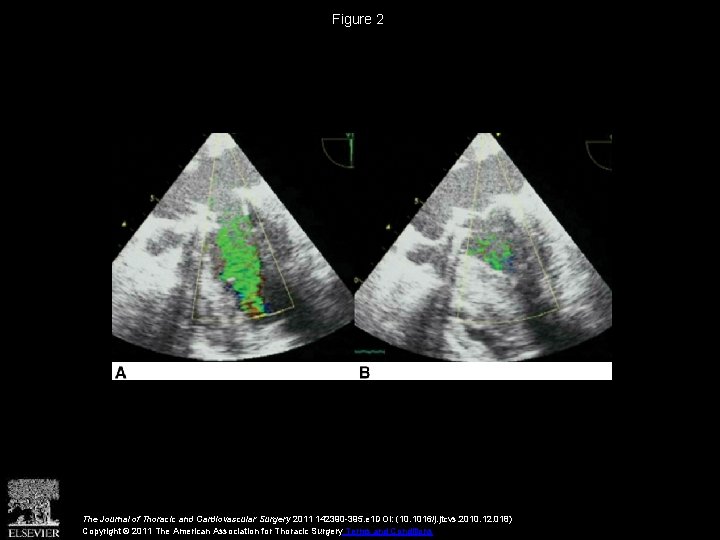 Figure 2 The Journal of Thoracic and Cardiovascular Surgery 2011 142390 -395. e 1