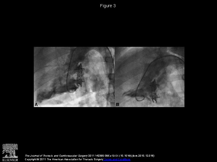 Figure 3 The Journal of Thoracic and Cardiovascular Surgery 2011 142390 -395. e 1