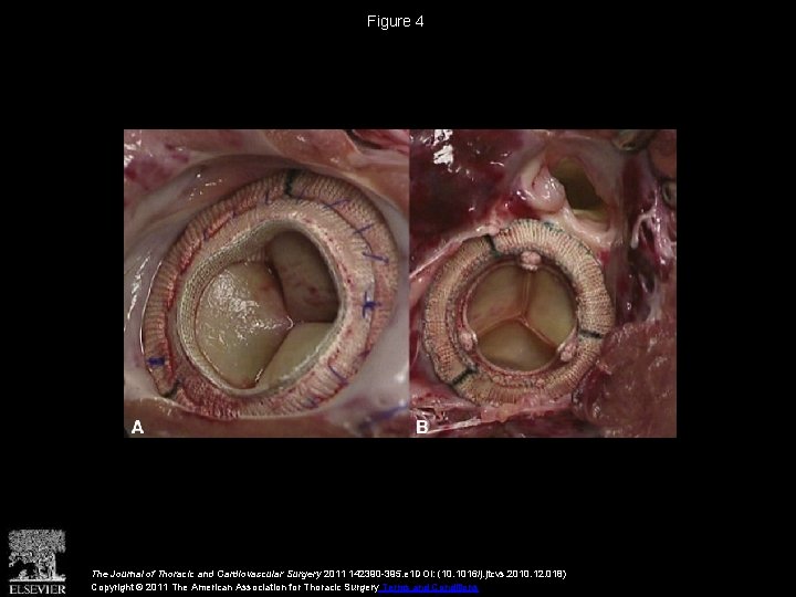 Figure 4 The Journal of Thoracic and Cardiovascular Surgery 2011 142390 -395. e 1