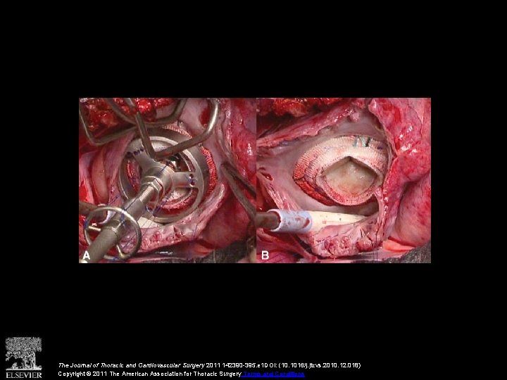 The Journal of Thoracic and Cardiovascular Surgery 2011 142390 -395. e 1 DOI: (10.