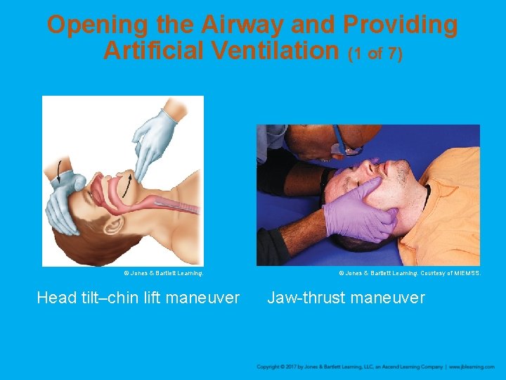 Opening the Airway and Providing Artificial Ventilation (1 of 7) © Jones & Bartlett