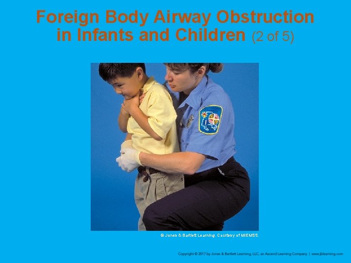 Foreign Body Airway Obstruction in Infants and Children (2 of 5) © Jones &