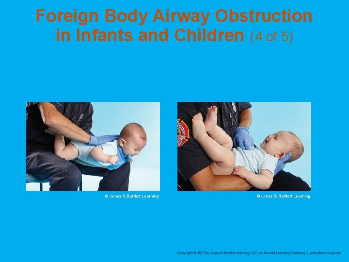 Foreign Body Airway Obstruction in Infants and Children (4 of 5) © Jones &