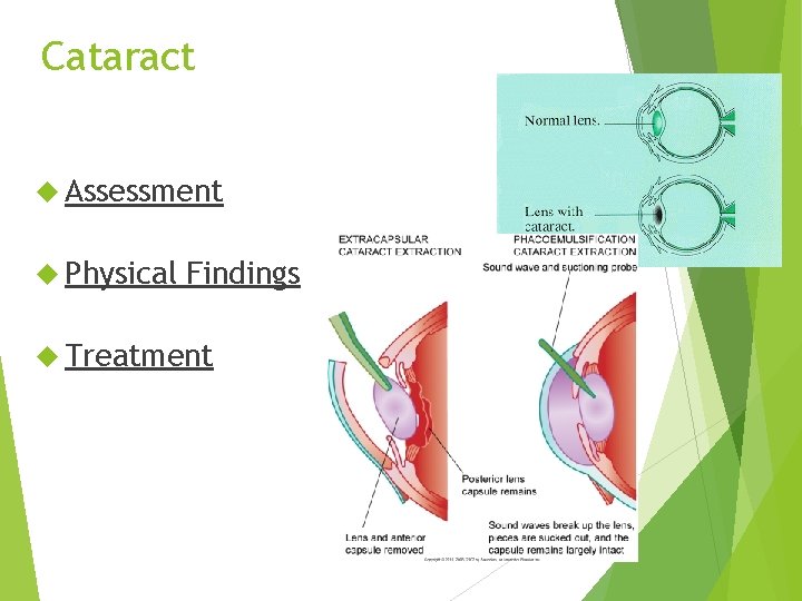 Cataract Assessment Physical Findings Treatment 