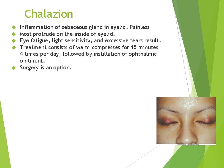 Chalazion Inflammation of sebaceous gland in eyelid. Painless Most protrude on the inside of