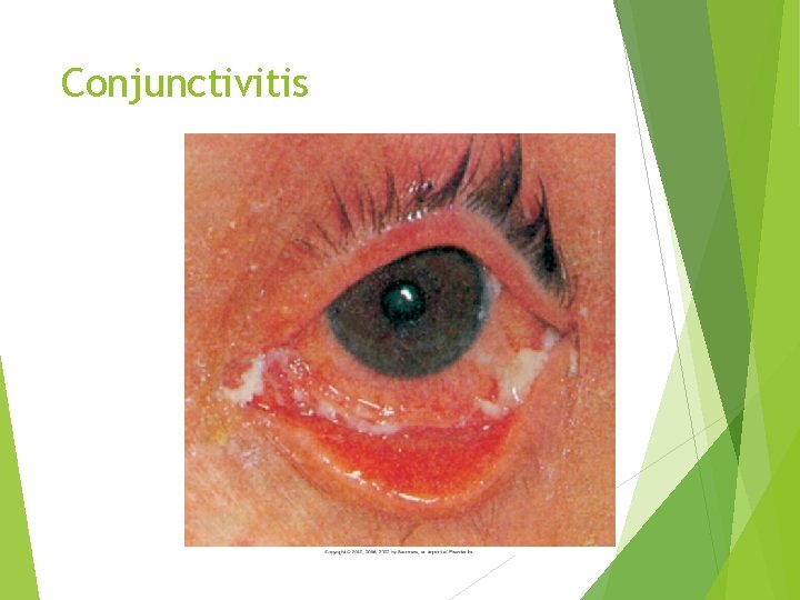 Conjunctivitis 