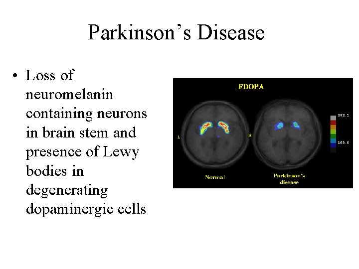 Parkinson’s Disease • Loss of neuromelanin containing neurons in brain stem and presence of