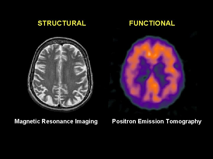 STRUCTURAL Magnetic Resonance Imaging FUNCTIONAL Positron Emission Tomography 