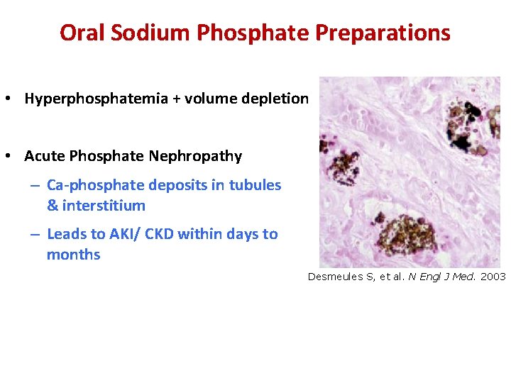 Oral Sodium Phosphate Preparations • Hyperphosphatemia + volume depletion • Acute Phosphate Nephropathy –