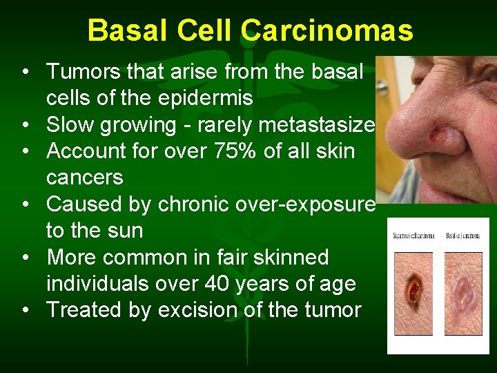 Basal Cell Carcinomas • Tumors that arise from the basal cells of the epidermis