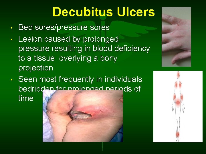 Decubitus Ulcers • • • Bed sores/pressure sores Lesion caused by prolonged pressure resulting