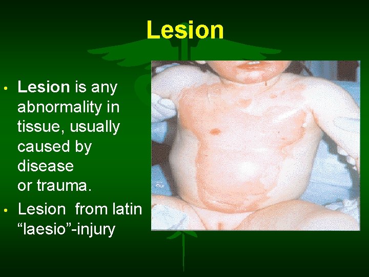 Lesion • • Lesion is any abnormality in tissue, usually caused by disease or