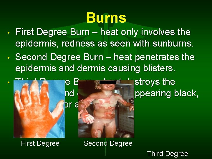 Burns • • • First Degree Burn – heat only involves the epidermis, redness