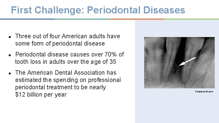 First Challenge: Periodontal Diseases ● Three out of four American adults have some form