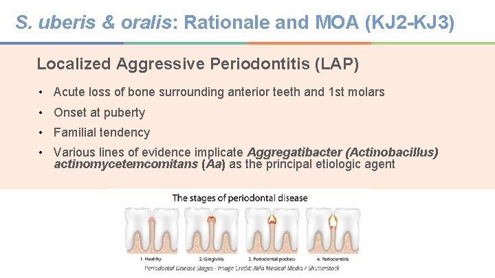 S. uberis & oralis: Rationale and MOA (KJ 2 -KJ 3) Localized Aggressive Periodontitis
