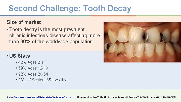 Second Challenge: Tooth Decay Size of market • Tooth decay is the most prevalent