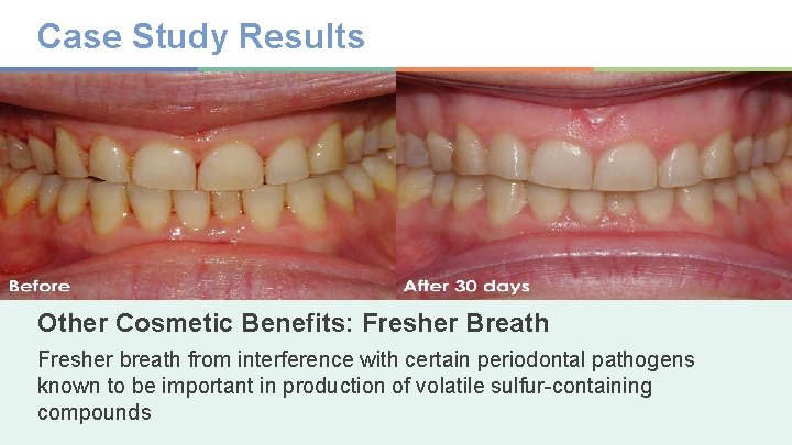 Case Study Results Source: Dr. Alan Slootsky, DMD. Other Cosmetic Benefits: Fresher Breath Fresher