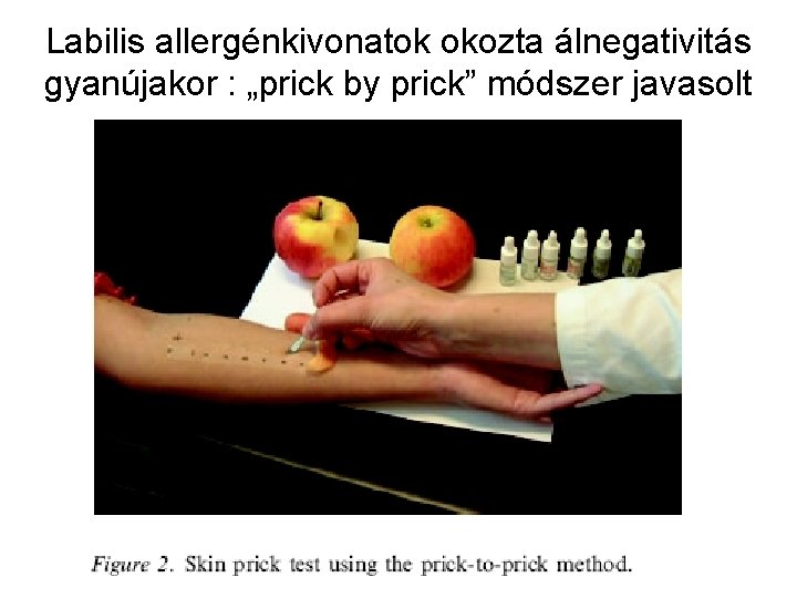 Labilis allergénkivonatok okozta álnegativitás gyanújakor : „prick by prick” módszer javasolt 