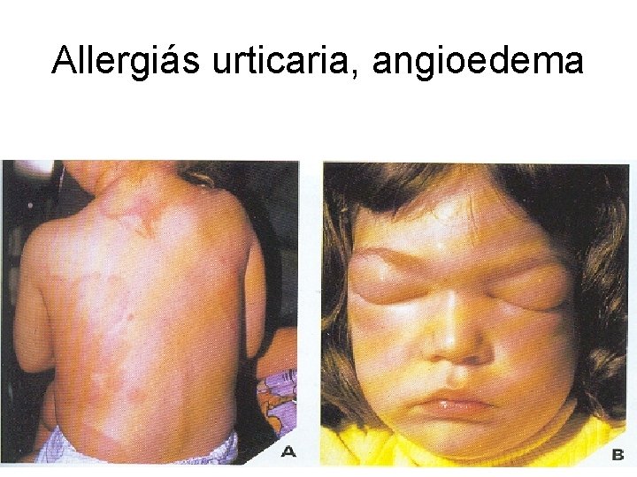 Allergiás urticaria, angioedema 